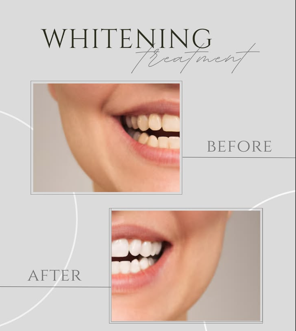 Dental cleaning at Omkar Clinic